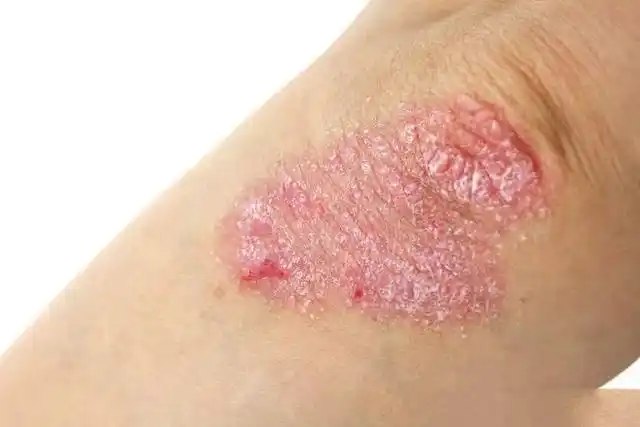 真菌性皮肤病图片