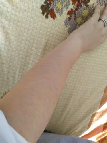 一个女孩子腿上,胳膊上,汗毛特别重……怎么回事,我这一看吓死我了!