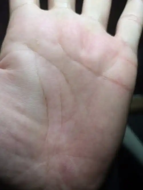 都说生命线有岛纹不好,哪位大师帮我看看