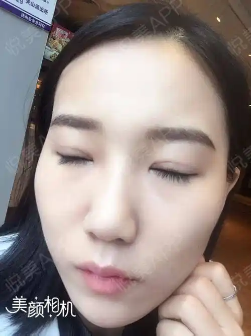 双眼皮术后23天_眼部整形术后23天_颜值精选术后23天_琪琪妞分享图片8