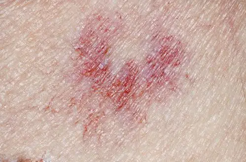 29岁女子因为皮肤过敏,查出肝癌,提醒:身体3个"异常"早重视