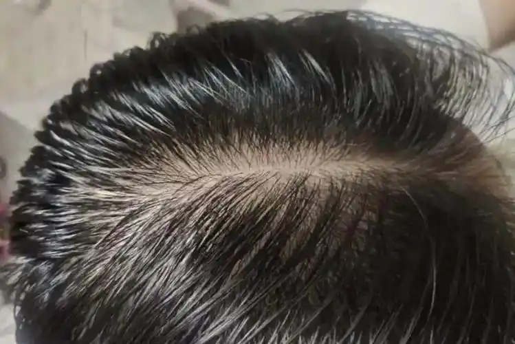 脂溢性脱发早期