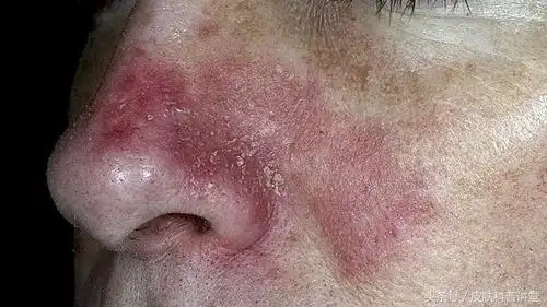 头皮屑多头皮痒掉头发该怎么治脂溢性皮炎的烦恼