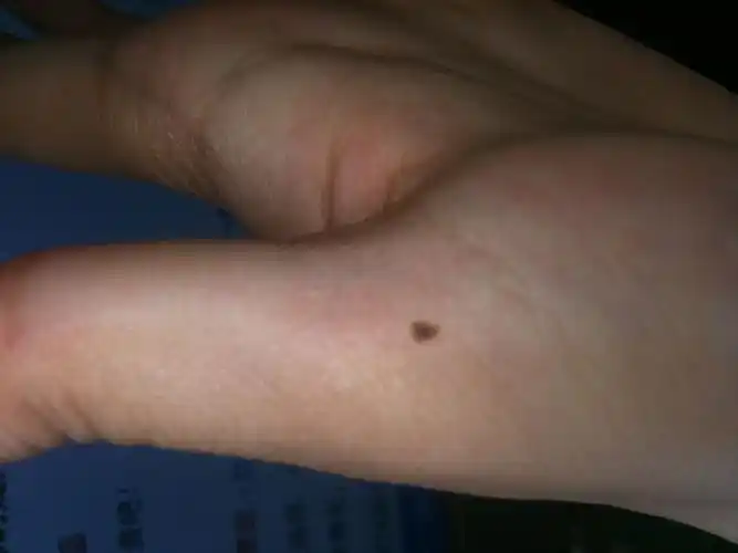 大拇指根部有痣图解 大拇指有痣图解大全-图片大观-奇异网