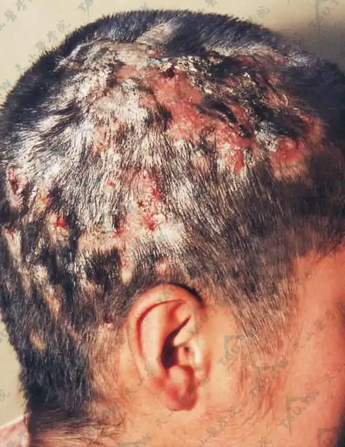 头发部多数毛囊炎,成半球形结节,淡红色,结节破溃后成为多数瘘孔,有脓