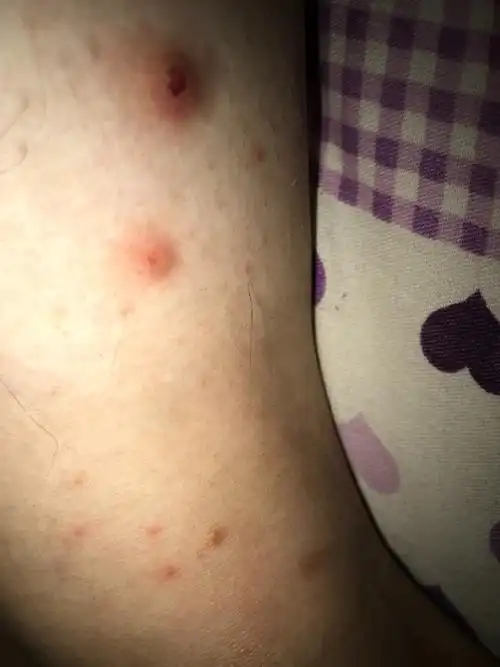 腿上起两个疙瘩特别痒都挠破了,从一个小疙瘩开始