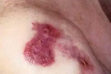 梅毒的检查费用是多少