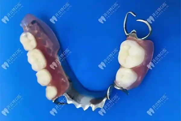 千万不要戴活动假牙关于活动义齿的优缺点及价格表看这里