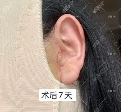 小切口拉皮手术7天疤痕图