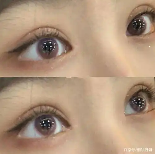 案例分享|全切双眼皮,双眼皮形态不好看能通过割双眼皮调整吗?