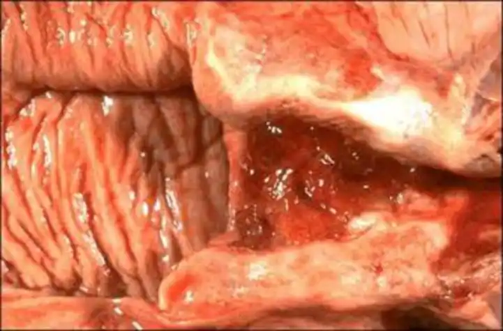 妇科疾病霉菌性阴道炎图片_有来医生