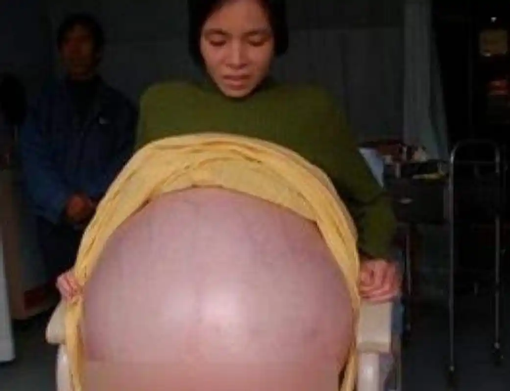 2009年,广东一女子怀孕肚子大到人难以站立,婆婆欣喜,这一定得有五