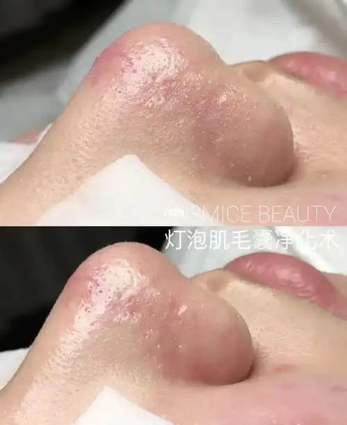 小气泡深层清洁黑头粉刺