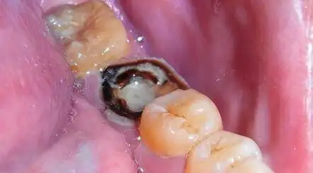 有个大牙洞之前疼得要命蛀牙非常严重怎么治