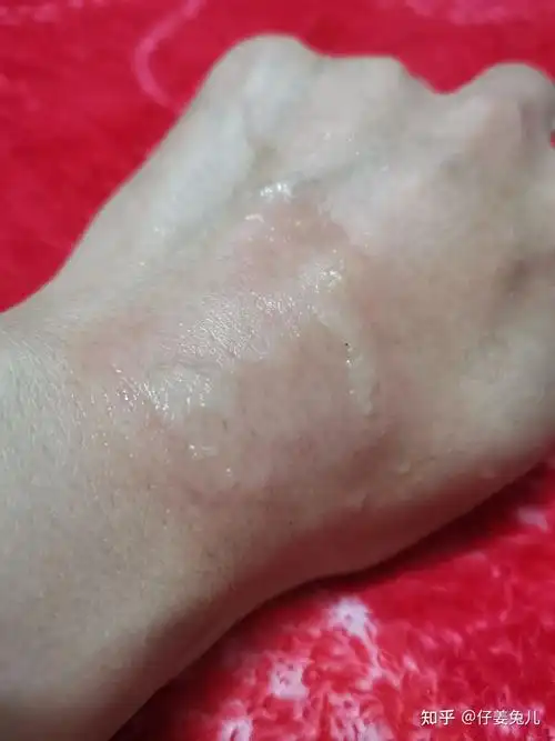 暖水袋烫伤恢复日记