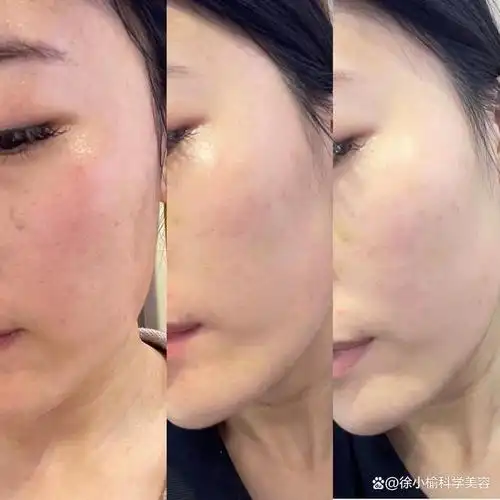 打水光针能不能改善敏感皮肤?