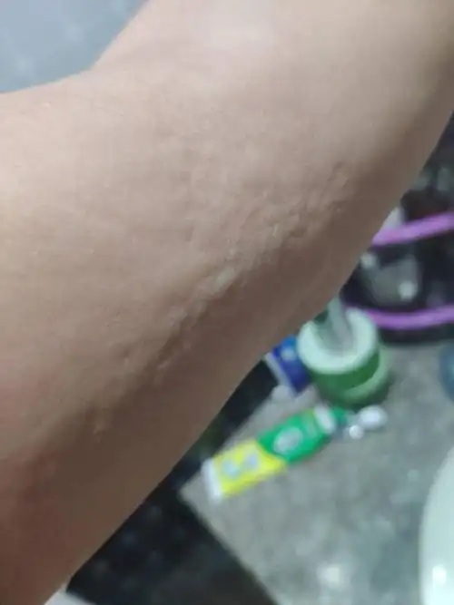 皮肤突然变成这样,会痒,是什么情况