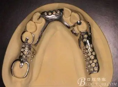 可摘局部义齿铸造支架修复中常见的卡环种类及作用