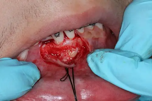 3颗阻生尖牙的牵引