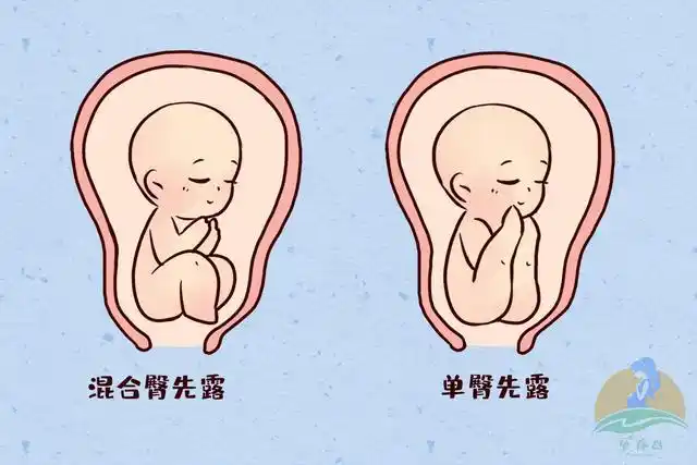 临产前发现胎儿臀位,真的只能"挨一刀"吗?医生:试试这种方法