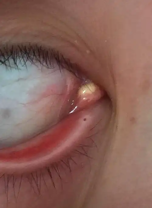 内眼角的位置长了一颗黄色的小颗粒是啥