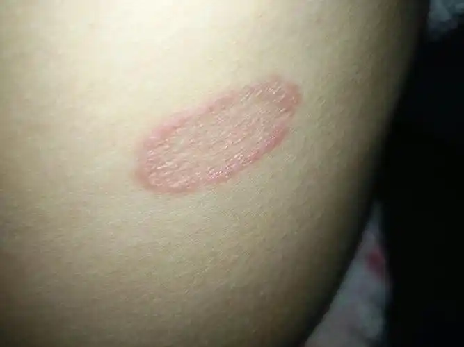 这是什么皮肤病,会痒会扩散. 用什么药