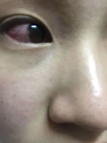 眼睛有血丝怎么回事