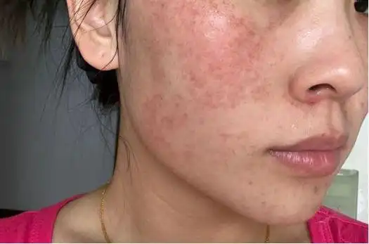 因素的变化,使得皮肤的屏障功能受损,容易受到外界刺激而产生过敏反应