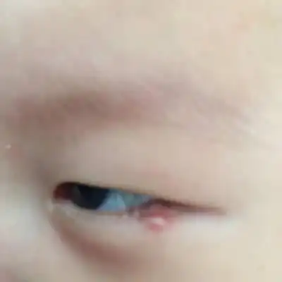 孩子眼角长了一个疙瘩,今天是第二天,比前一天大了一倍.怎麼办?