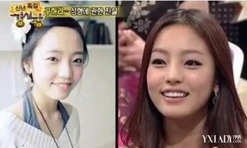 具荷拉整容后照片曝光