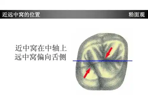 上颌第一磨牙牙体形态简述