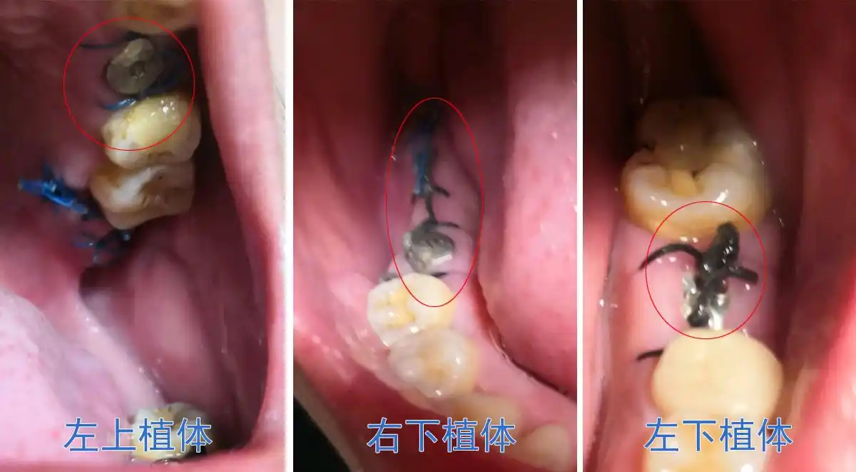 赤峰锦美口腔医院种植牙全部过程与感受