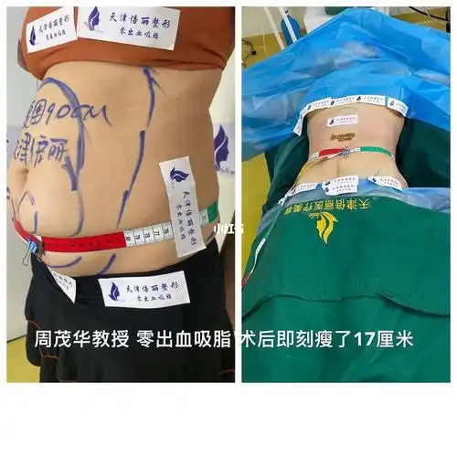 腹部吸脂# 剖腹产疤痕明显凹陷,美女生完宝宝后就一直没瘦下来,而且