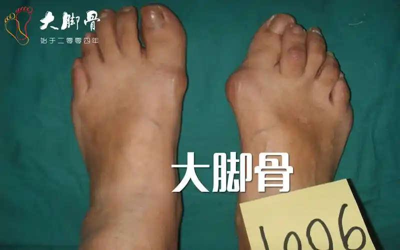 大脚骨拇外翻的介绍_哔哩哔哩 (゜-゜)つロ 干杯~-bilibili