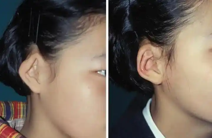 耳廓畸形修复前后对比