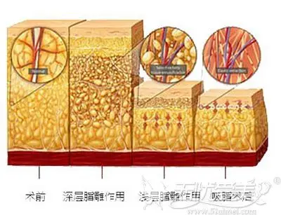腰腹部皮下脂肪层次