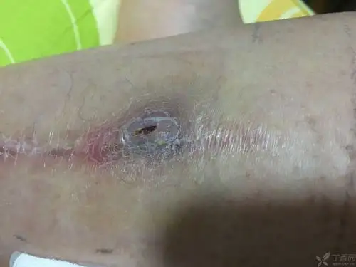 线结反应 - 感染 -丁香园论坛