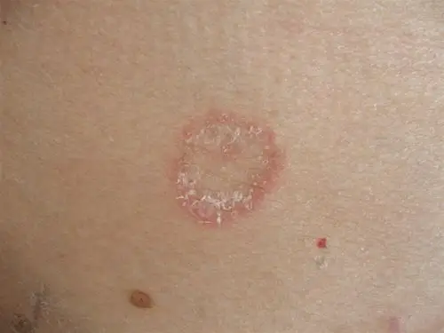 图示病例13 体癣