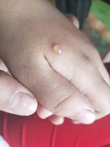 六岁孩子手上起了个水泡透明 黄豆大小 周围稍微有点红 怎麼回事