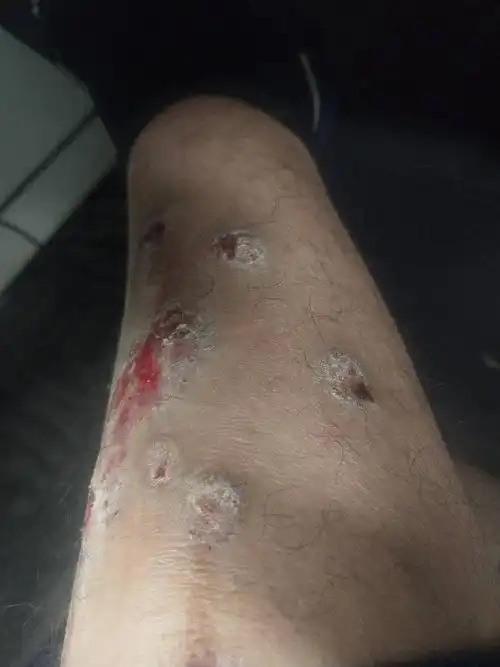 看了几个医生,有的说神经性皮炎的,有的说是痒疹的,到底是啥啊?