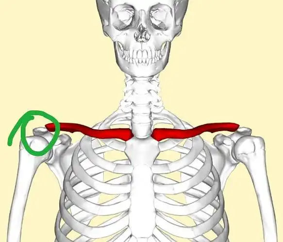 刚才百度了下,大概是下图里面绿色圈圈那个骨头突出了