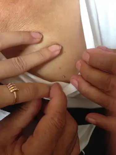 老人身上长的这种肉球是什么东西?不痛不痒,是什么皮肤病吗?