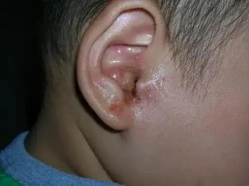 耳朵里也会起湿疹吗