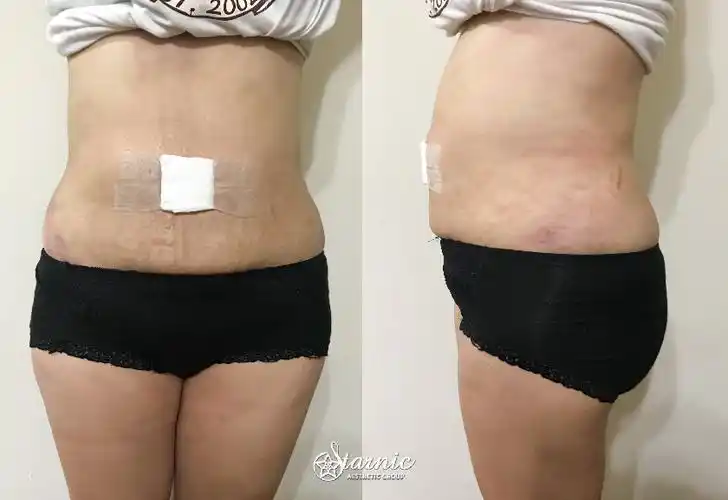 台中医美星和诊所_肚子抽脂_豆豆10