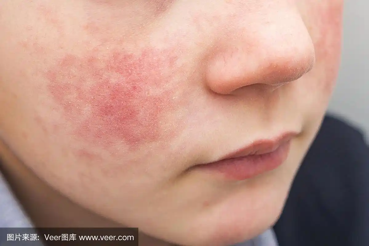 男孩脸颊红润-素质或过敏症状.面部皮肤发红,脱皮.