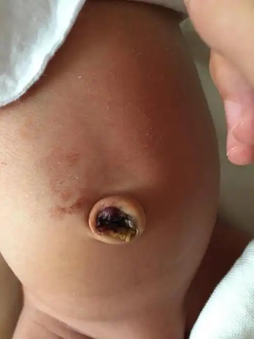 下面小编跟大家分享一下怎样护理重生儿肚脐1,每天早晚要用酒精和碘水