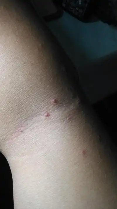 艾滋病红点图片 (46)