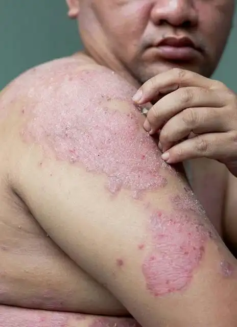 过敏性皮肤炎早期症状图片_银屑病求医网