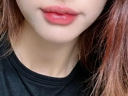 嘟嘟唇 轻微m唇记录微调嘴唇第5天～玻尿酸丰唇,扎_圈子-新氧美容整形