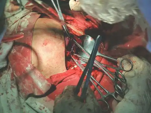 剖腹产现场实拍:宝宝是如何生出来的(图)_亲子频道_凤凰网